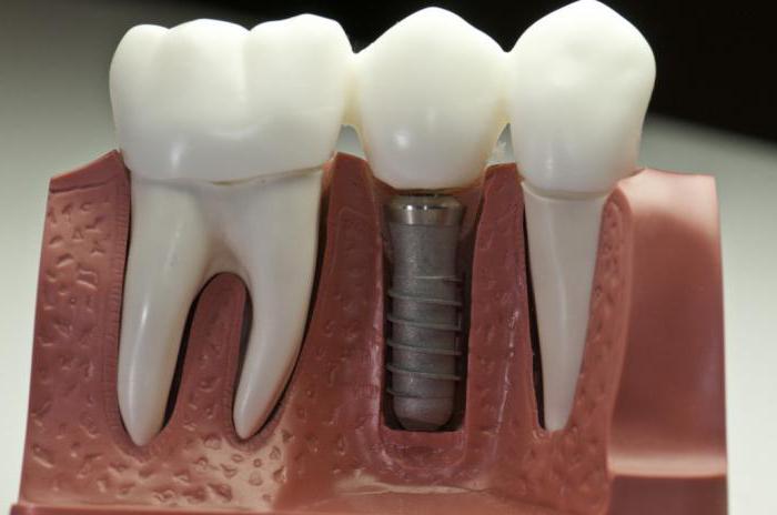 jakie są najlepsze recenzje implantów mostowych lub dentystycznych