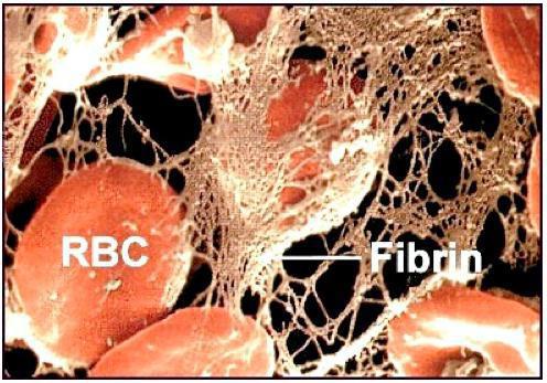 příčiny zvýšeného fibrinogenu v krvi