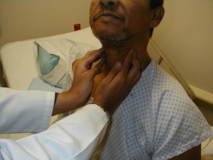 rozšířené lymfatické uzliny v krku