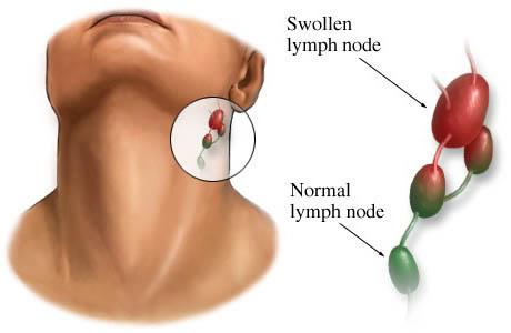 limfni vozel vnetje pod čeljustjo
