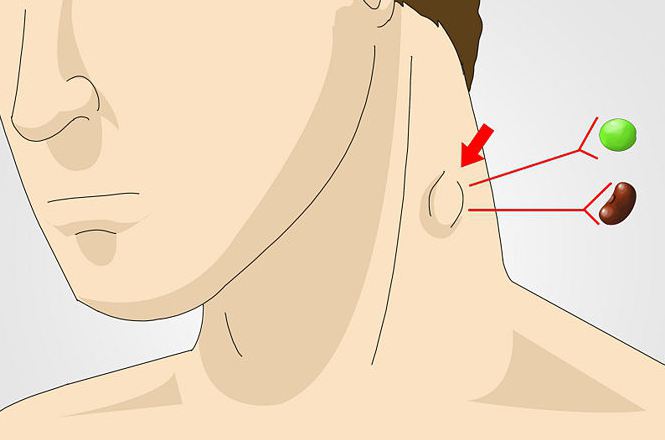 отечени лимфни чвор у врату што треба учинити
