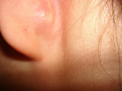 възпаление на лимфните възли зад ухото