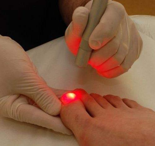 rimozione laser dell'unghia incarnita