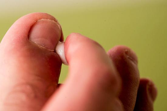вродено лечение на ноктите на краката