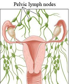 linfonodi inguinali nelle donne