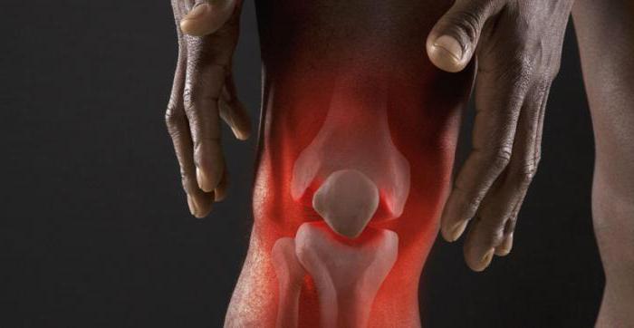 artroza homeopatskog liječenja zgloba koljena