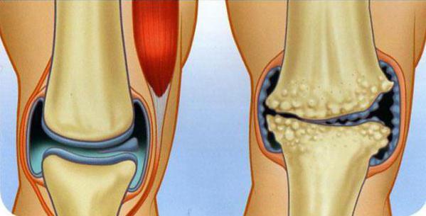 liječenje artroze koljena homeopatijom