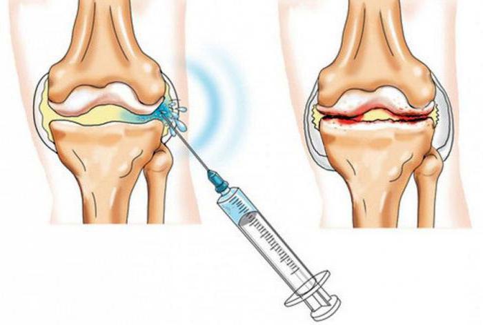 injekcije za bol u zglobu koljena intramuskularno