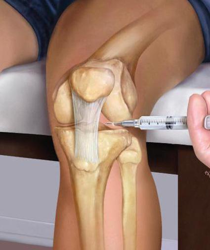 injekcije boli u zglobu koljena