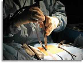 trattamento del laser intervertebrale di ernia