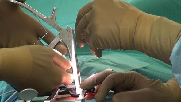 интервертебрална херния лумбална хирургия