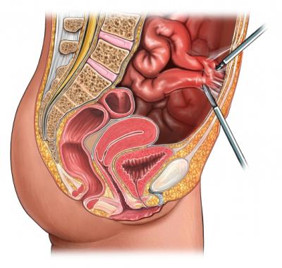 laparoskopske crijevne adhezije