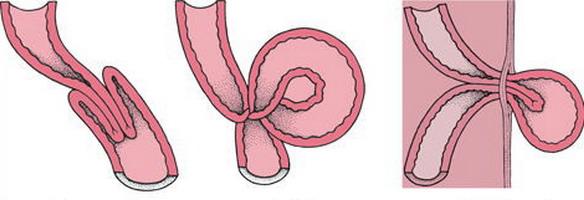 crijevna opstrukcija