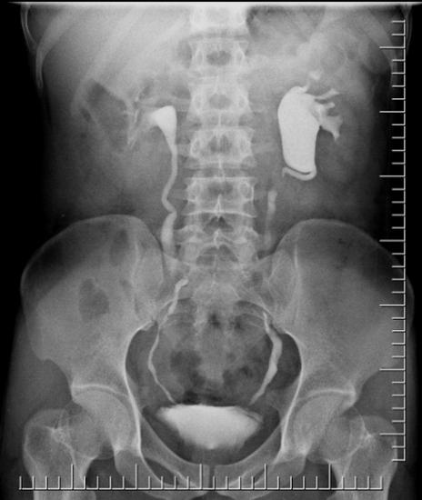 urografia endovenosa dei reni