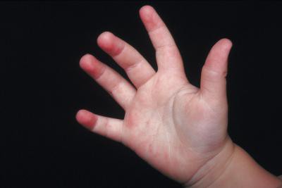 irritazione nelle mani di un bambino