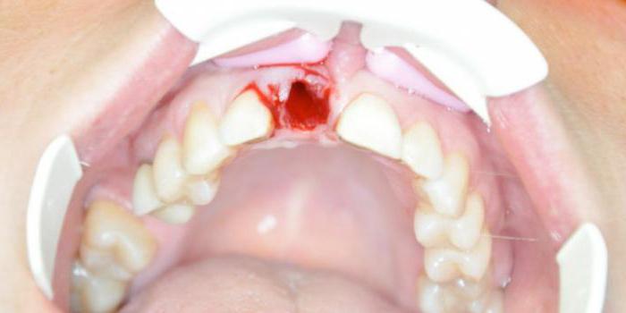 E 'possibile fumare dopo l'estrazione del dente?