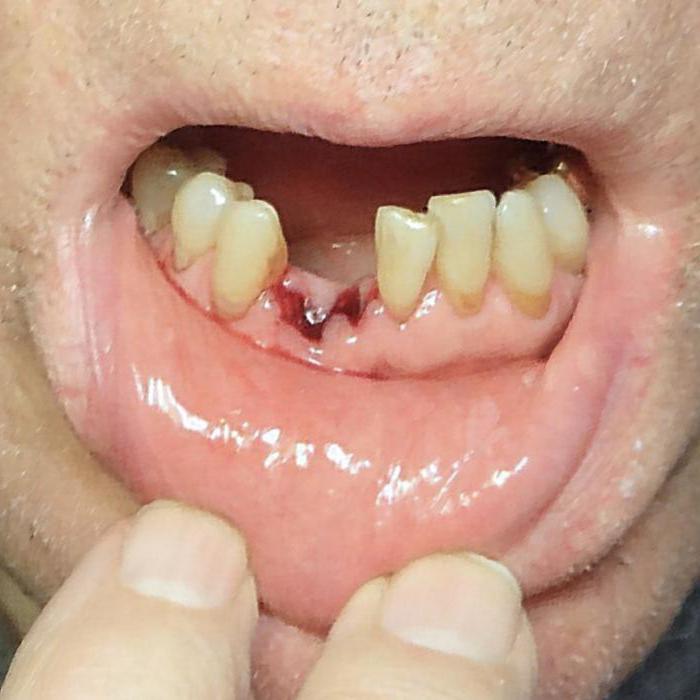 je možné kouřit po odstranění zubu z osmi