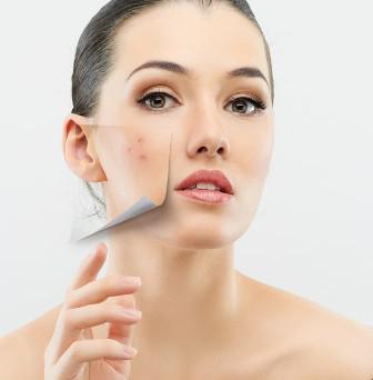 lo iodio aiuta per l'acne