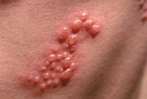 il trattamento dei sintomi di herpes zoster è contagioso