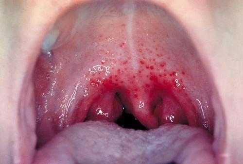 gonfiore della gola