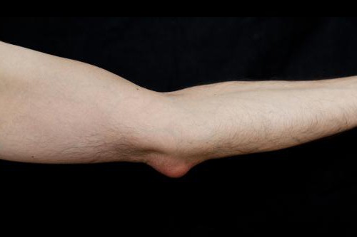 masti za bolove u zglobovima lakta liječenje osteoartritisa cijene stopala