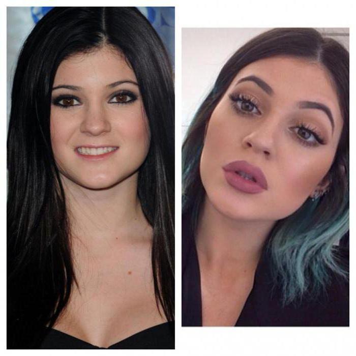 Kylie Jenner před a po plastu