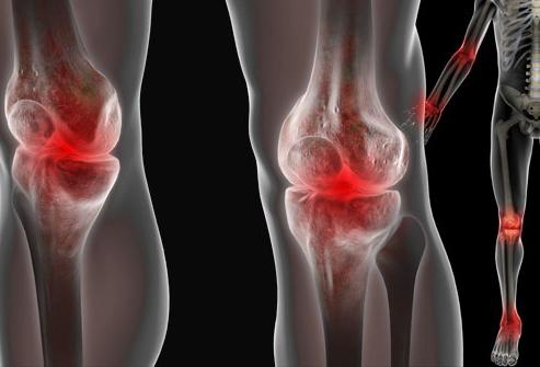 tretman artroza i operacije bol u zglobovima kod artritisa