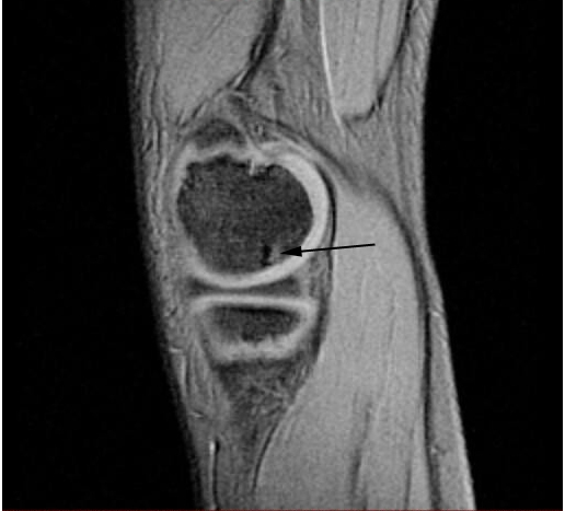 malattia dell'articolazione del ginocchio