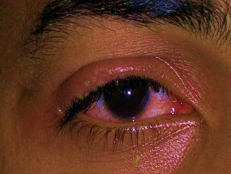 очите на кератит