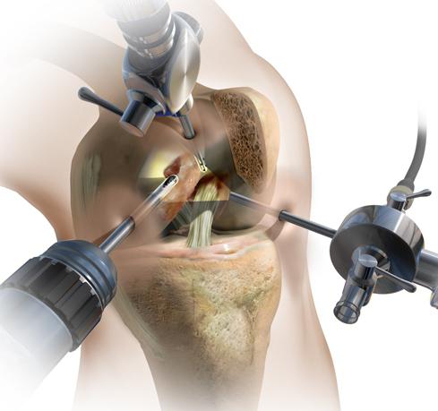 chirurgia artroscopica al ginocchio