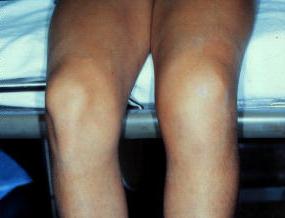 trattamento per lesioni al ginocchio