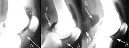 radiografia dell'articolazione nella malattia goff