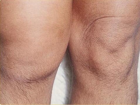 хроничен синовит на коляното
