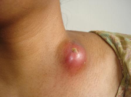 tuberkulóza lymfatických uzlin
