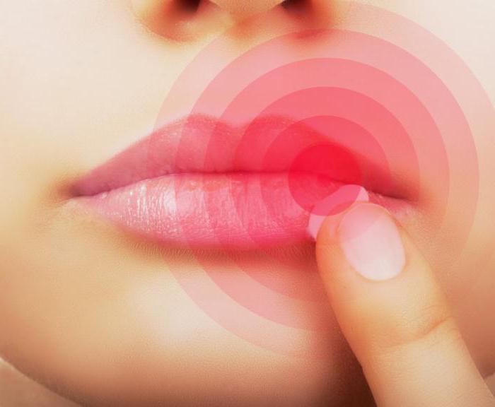 какво помага при настинки на устните