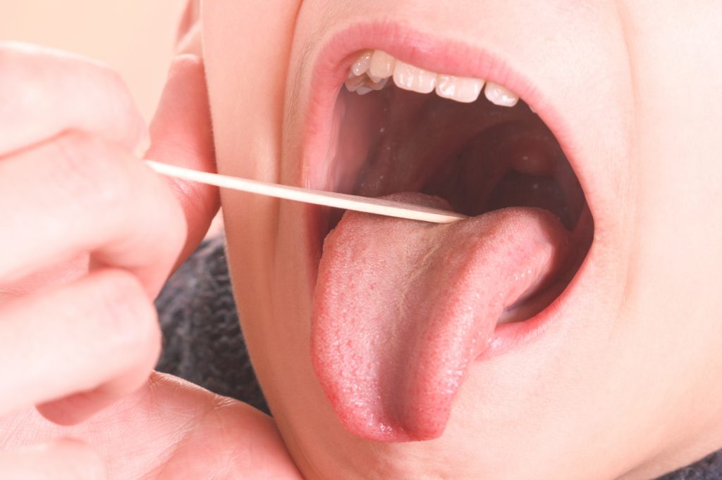 tappo nelle fessure delle tonsille