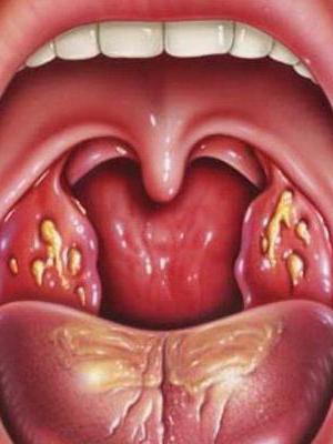 trattamento con tonsillite lacunare nei bambini