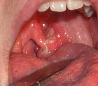 Lacunarni tonzilitis, simptomi