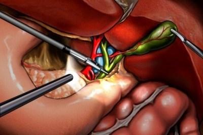 laparoskopia pęcherzyka żółciowego