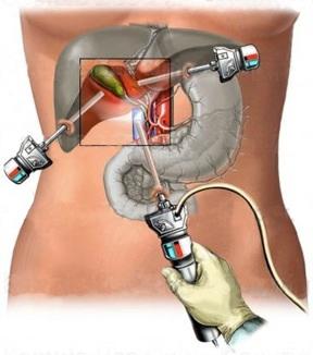 Gli effetti della laparoscopia