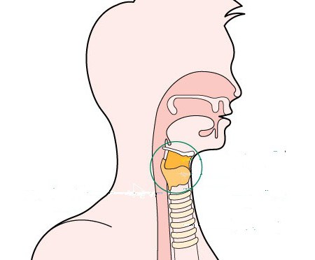 Stenosi della laringe nei bambini