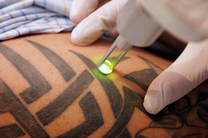 Odstranjevanje tattooja pred in po