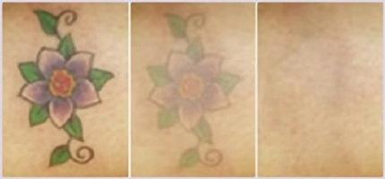 Odstranjevanje laserskega tetoviranja z neodimijem