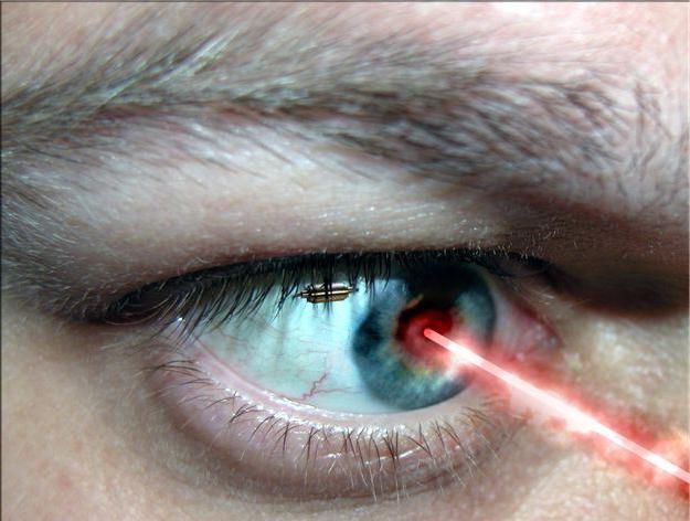 correzione della visione laser