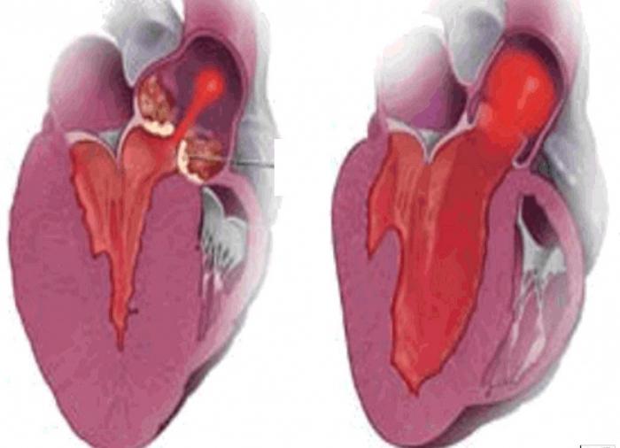 ecg ipertrofia ventricolare sinistra