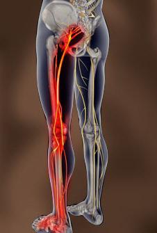 vzroki bolečine v nogah s kolka