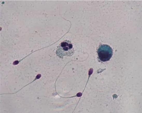 bílé krvinky způsobené spermatem
