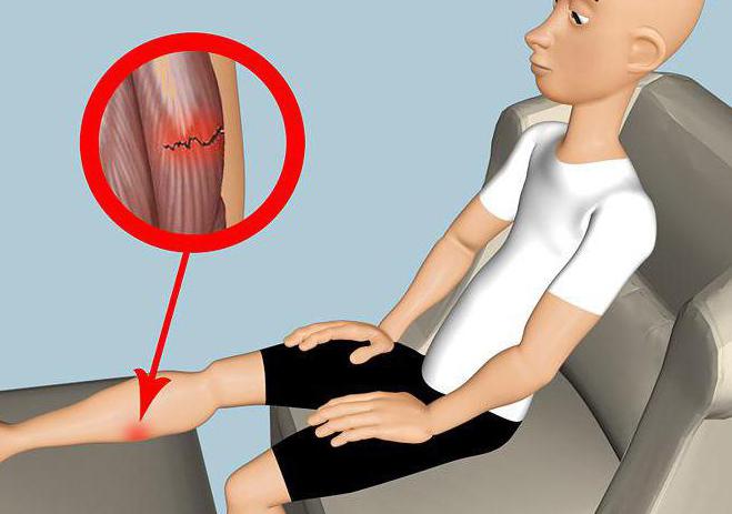 как да се лекуват разкъсани връзки на крака