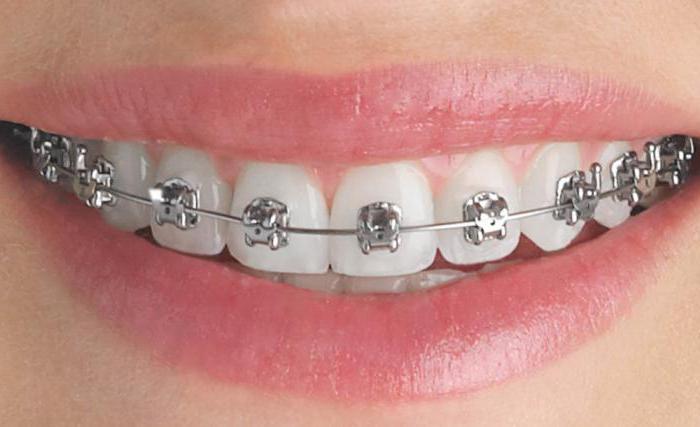 aparaty ortodontyczne