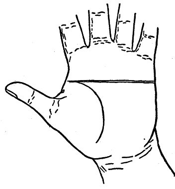 кирургија на руци